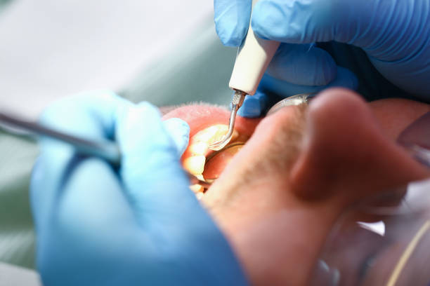 Best Emergency Root Canal Treatment in Torrington, CT