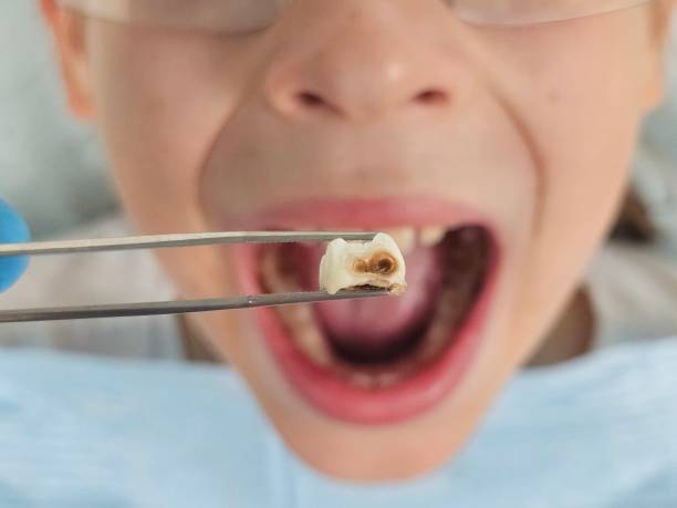 Best Broken or Cracked Tooth Emergency Dentist in Torrington, CT